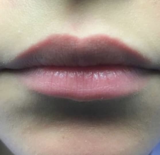 Before Image: Lip Augmentation - front