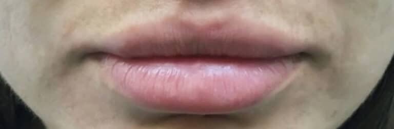 After Image: Lip Augmentation - front