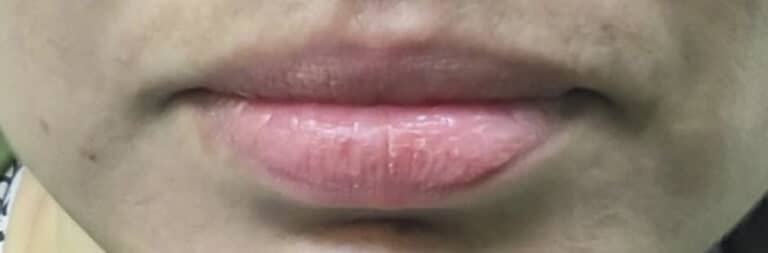 Before Image: Lip Augmentation - front