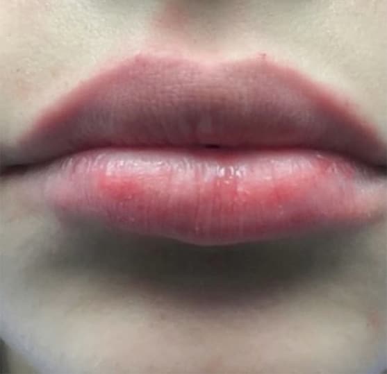 After Image: Lip Augmentation - front