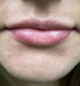 After Image: Lip Augmentation