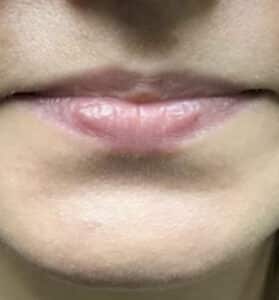 Before Image: Lip Augmentation