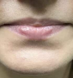 Lip Augmentation