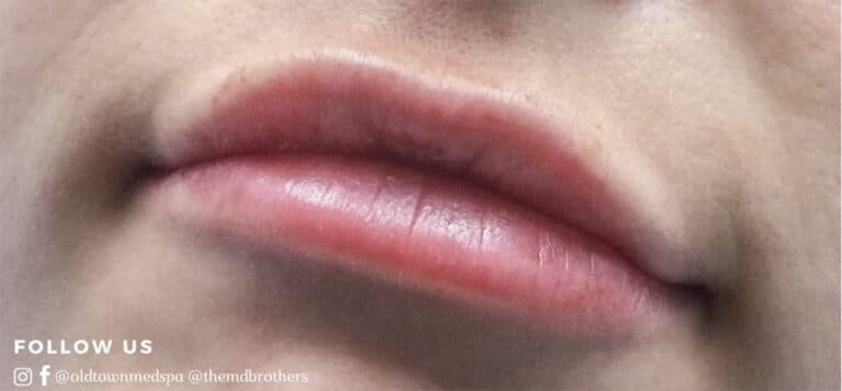 After Image: Lip Augmentation - left-front-oblique