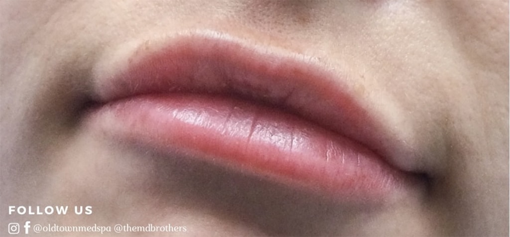 After Image: Lip Augmentation - left-front-oblique