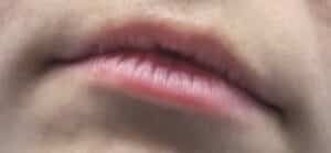 Before Image: Lip Augmentation