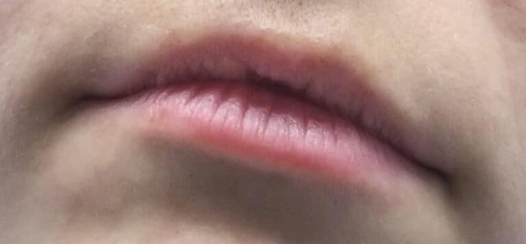 Before Image: Lip Augmentation - left-front-oblique
