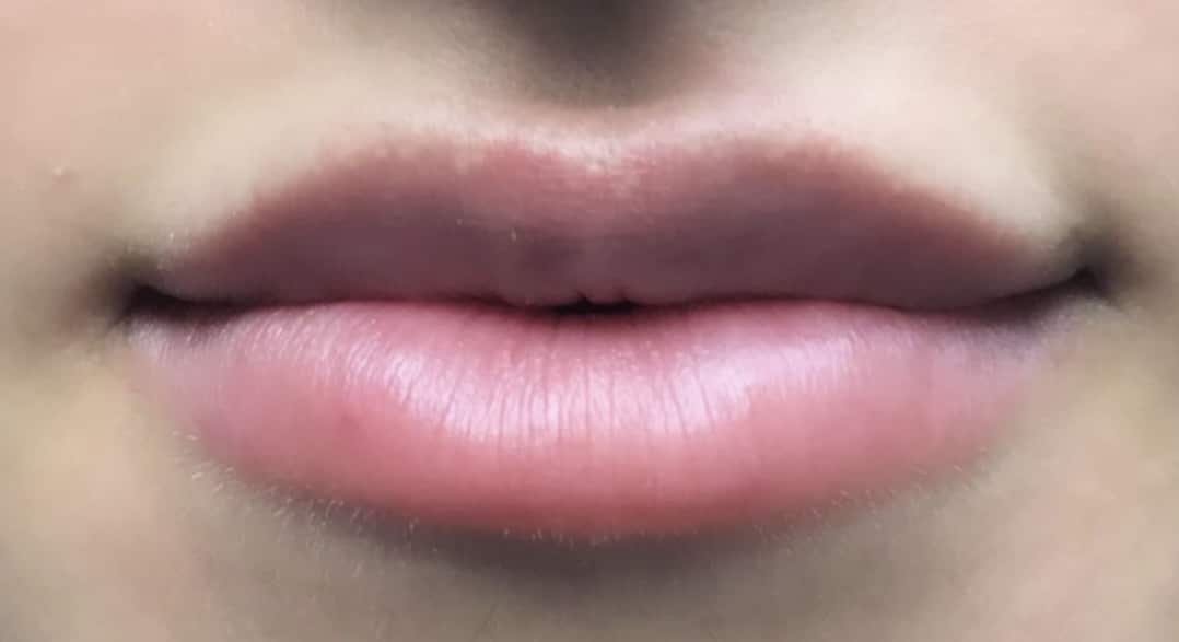 After Image: Lip Augmentation - front