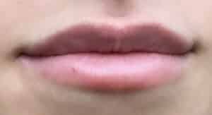 Before Image: Lip Augmentation