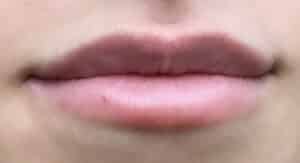 Lip Augmentation