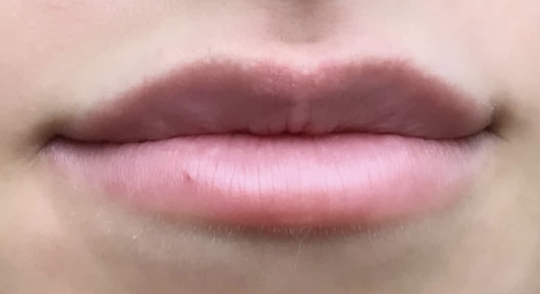 Before Image: Lip Augmentation - front