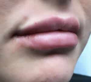 After Image: Lip Augmentation