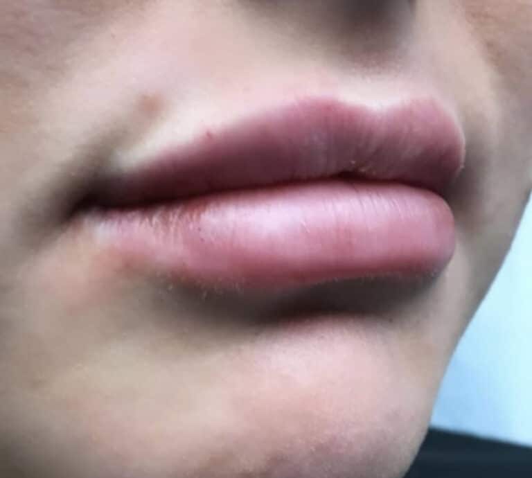 After Image: Lip Augmentation - right-front-oblique