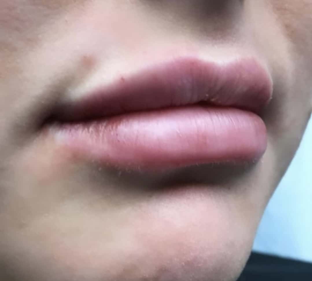 After Image: Lip Augmentation - right-front-oblique