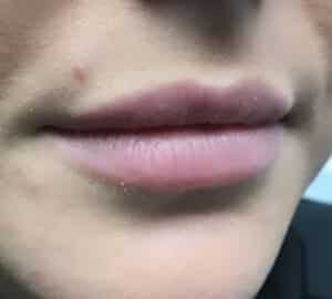 Before Image: Lip Augmentation