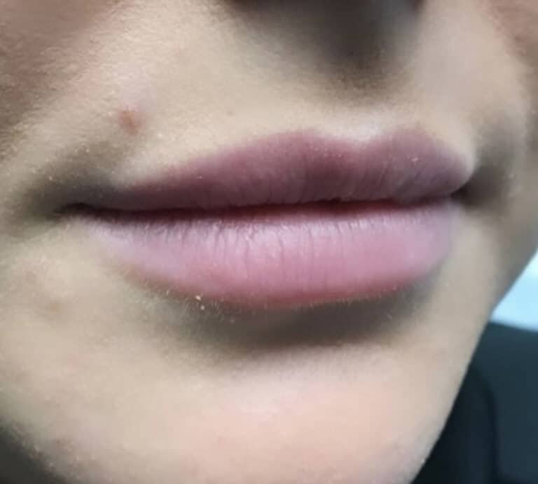 Before Image: Lip Augmentation - right-front-oblique