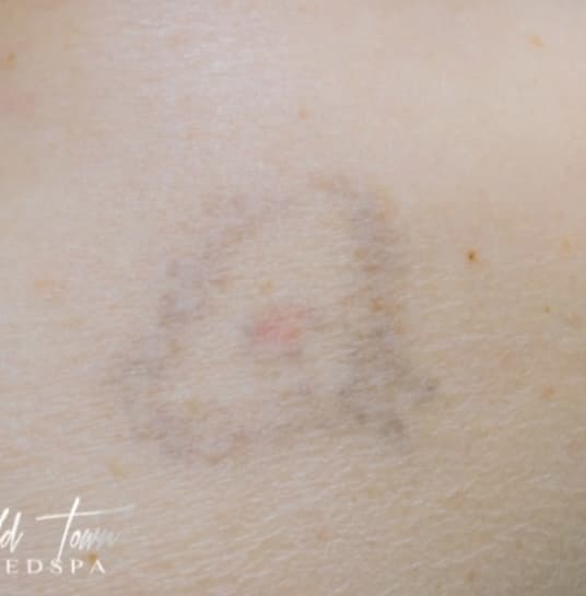 After Image: Laser Tattoo Removal - front