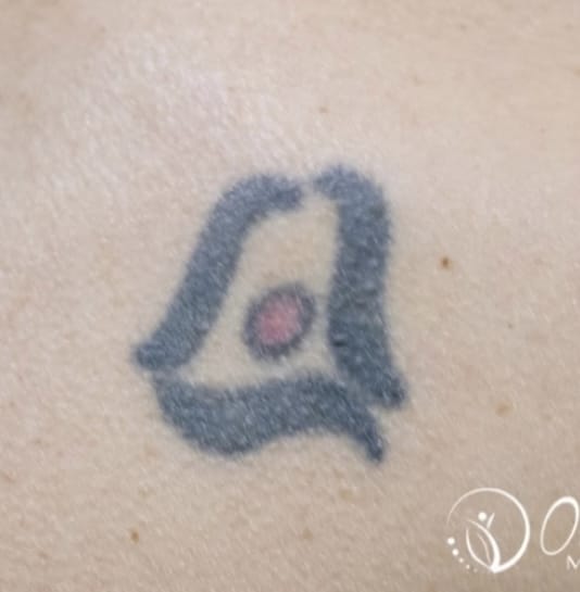 Before Image: Laser Tattoo Removal - front