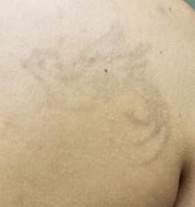 After Image: Laser Tattoo Removal