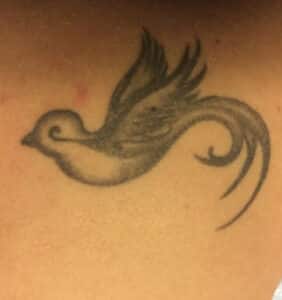 Before Image: Laser Tattoo Removal
