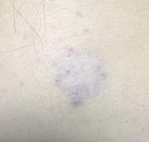 After Image: Laser Tattoo Removal