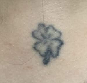 Before Image: Laser Tattoo Removal