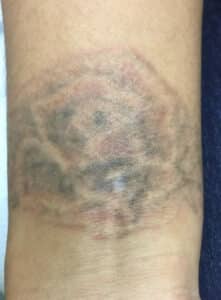 After Image: Laser Tattoo Removal