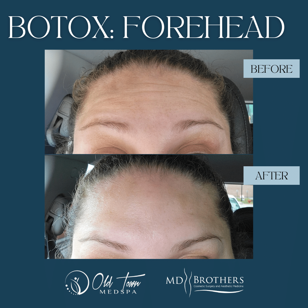 Forehead botox b&a