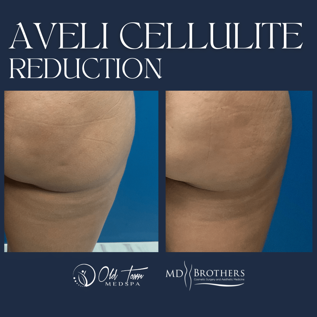 Before and After Aveli Cellulite Therapy in Lincoln Park IL