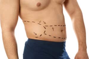 Young,Man,With,Marks,On,Belly,For,Cosmetic,Surgery,Operation