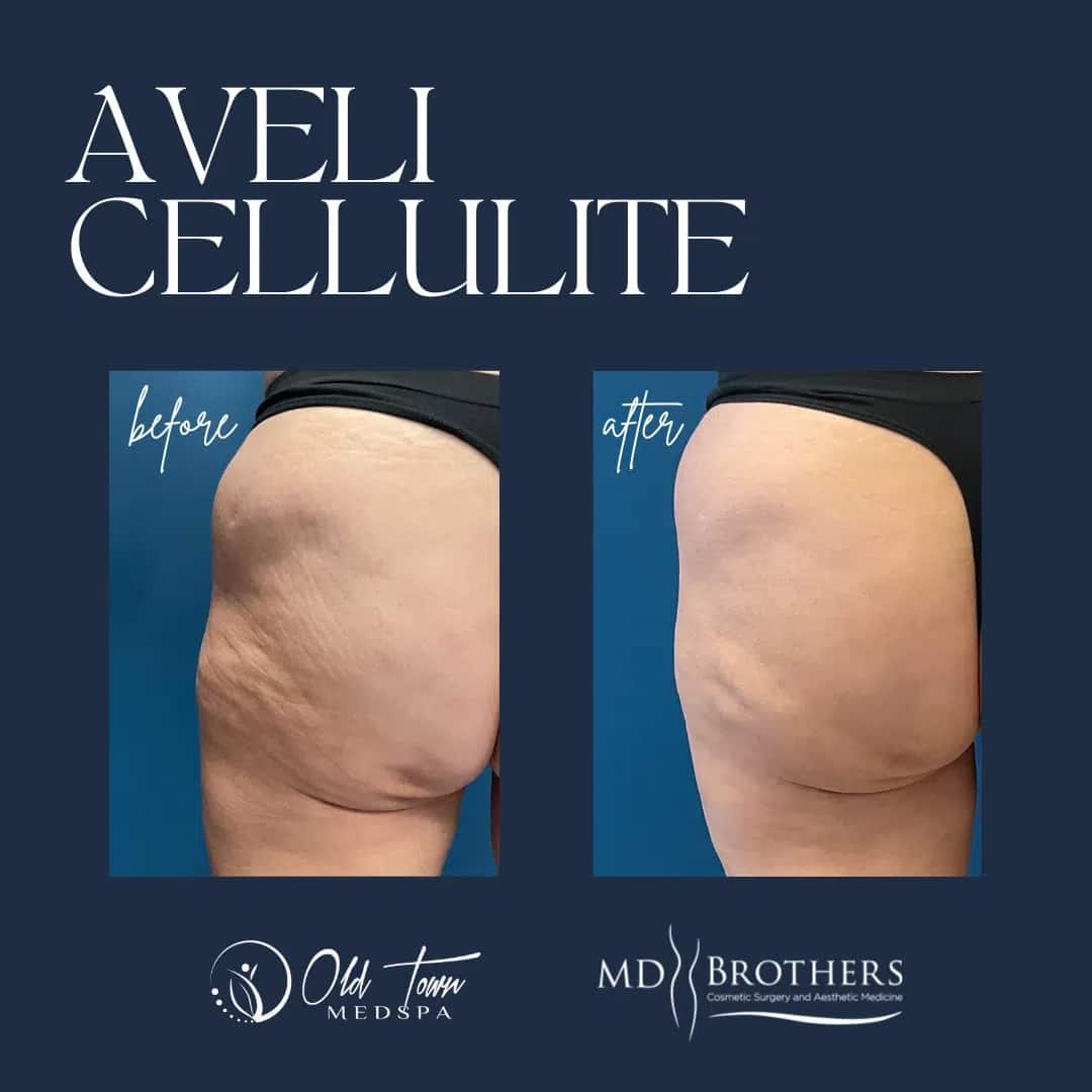 Before and After Aveli Cellulite in Chicago IL