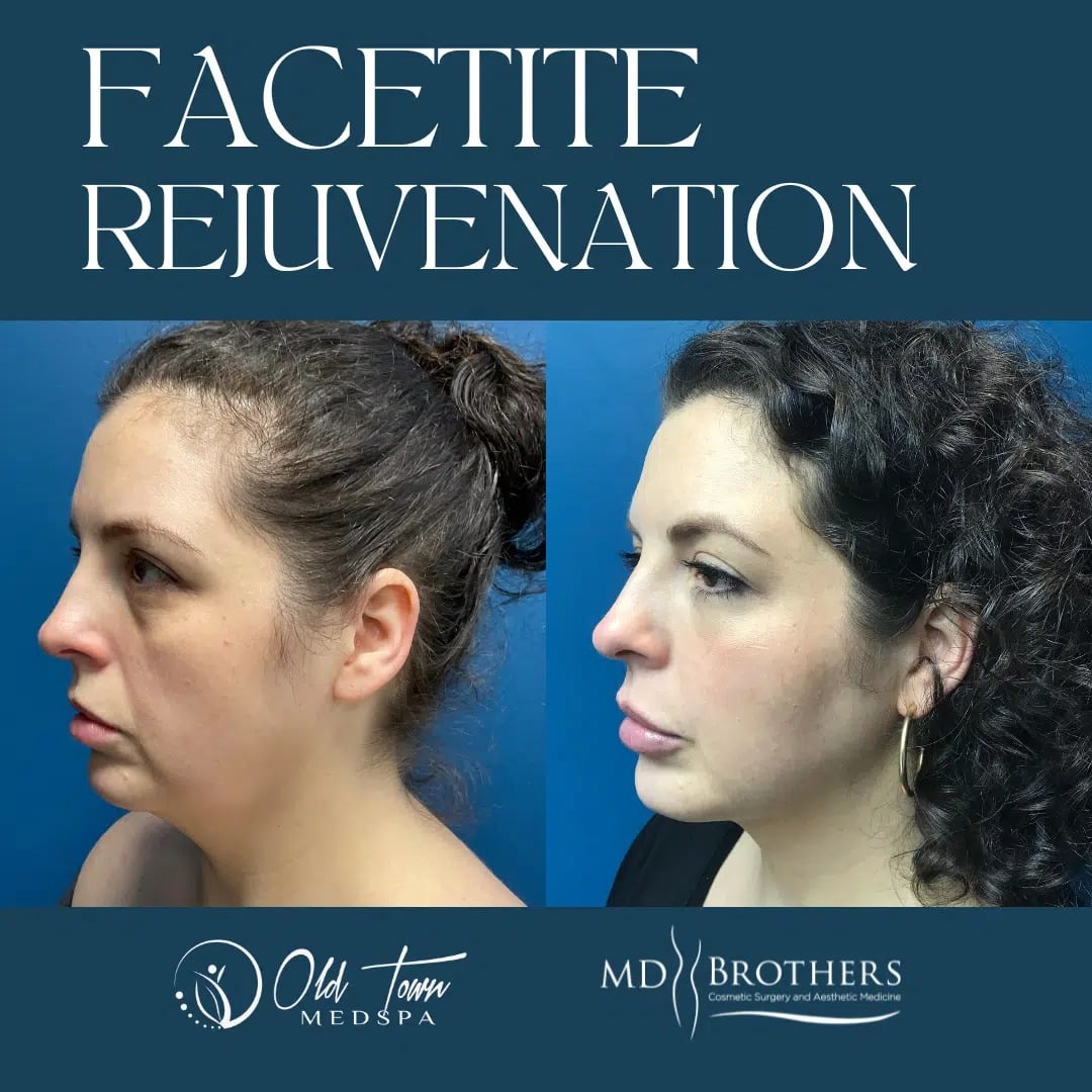 FACETITE REJUVENATION.png