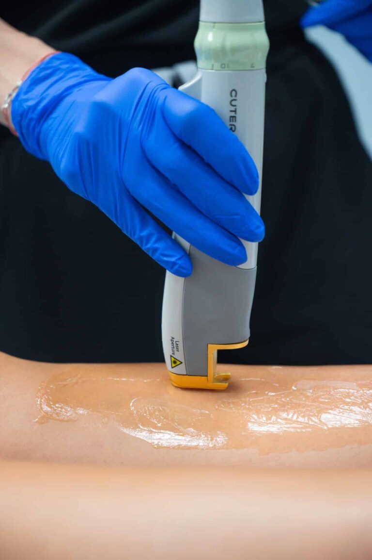 Laser Hair Removal in Chicago IL