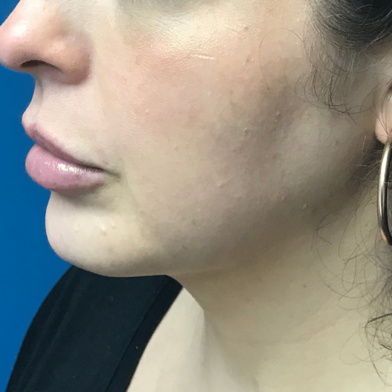 After Image: Chin Liposuction, Skin Tightening, & Facial Fillers - left-side