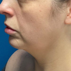 Chin Liposuction, Skin Tightening, & Facial Fillers