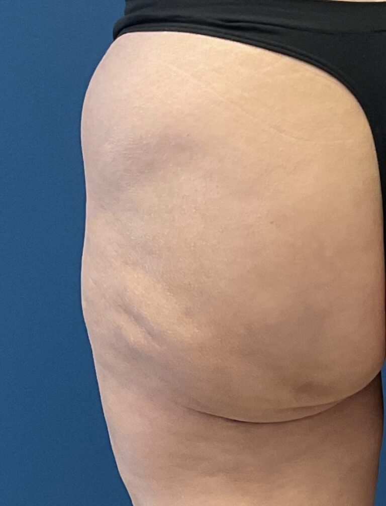 After Image: Aveli Cellulite - back