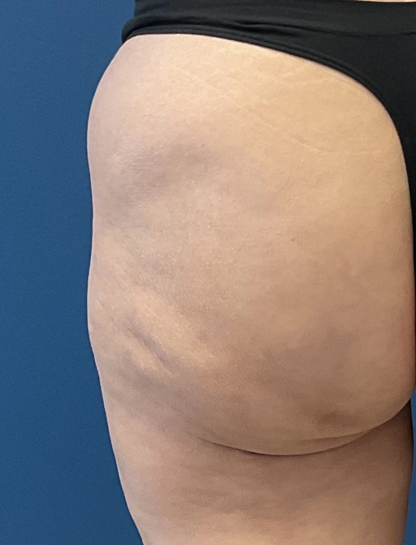 After Image: Aveli Cellulite - back
