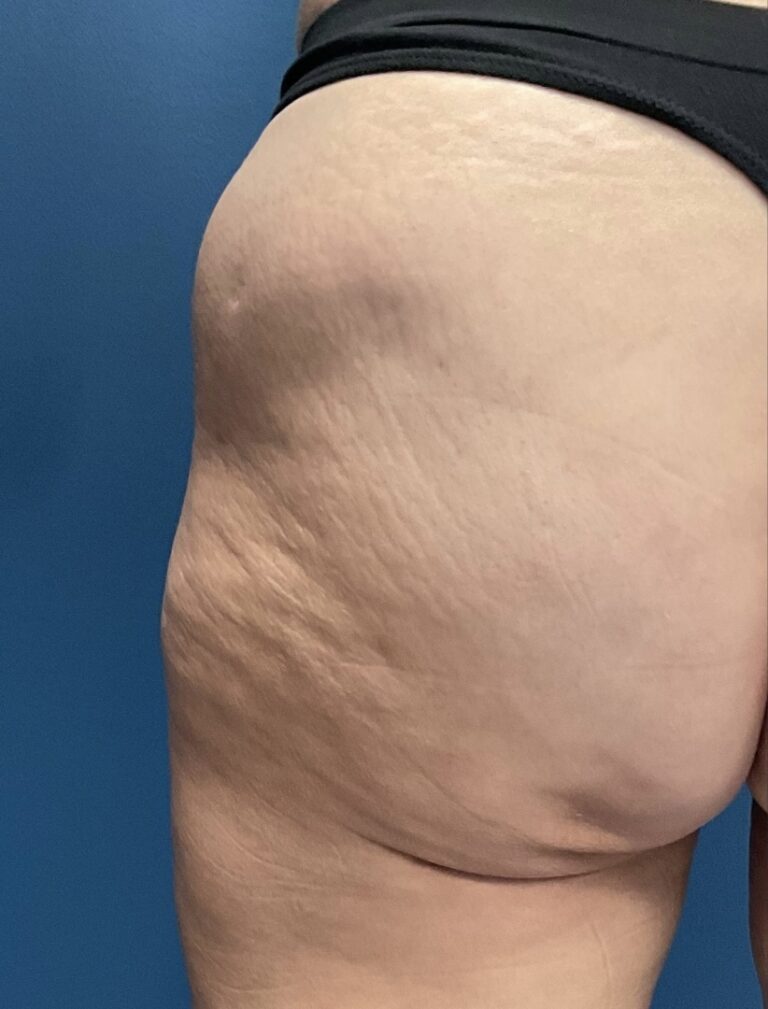 Before Image: Aveli Cellulite - back