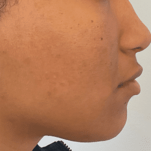 After Image: Custom Acne Plan