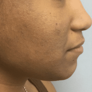 Before Image: Custom Acne Plan