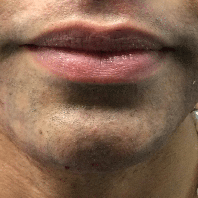 After Image: Chin Filler - front