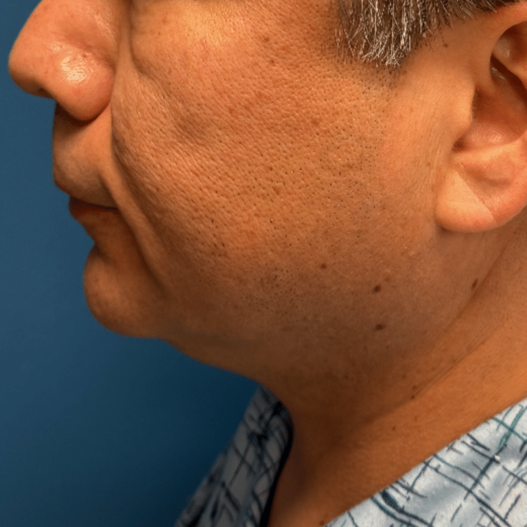 Before Image: Facial Liposuction and Skin Tightening - left-side