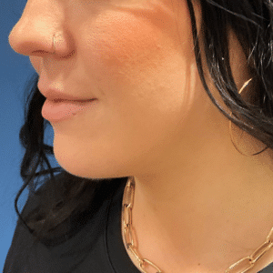 After Image: Chin Liposuction