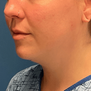 Before Image: Chin Liposuction