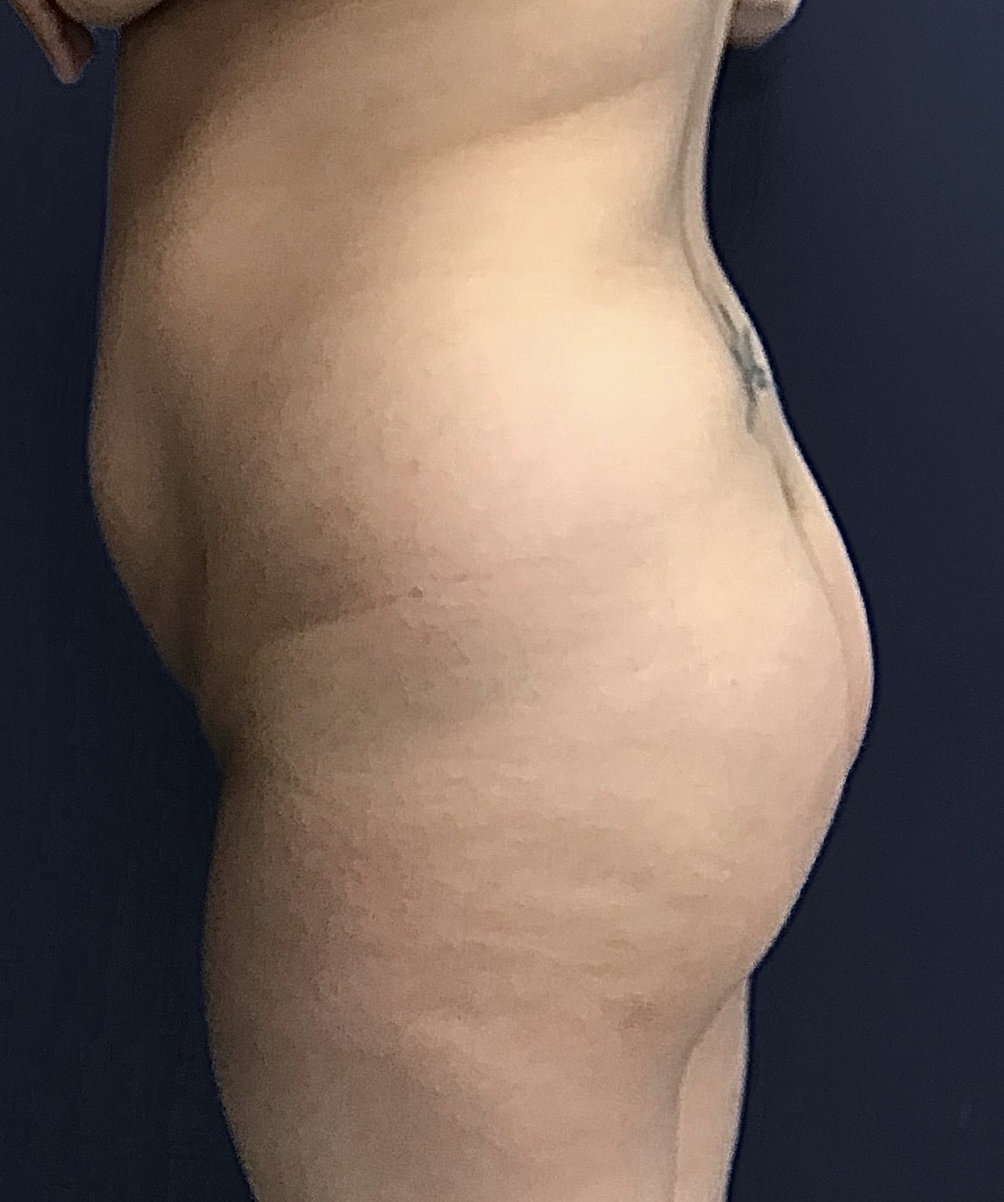 Before Image: Surgical BBL - left-side