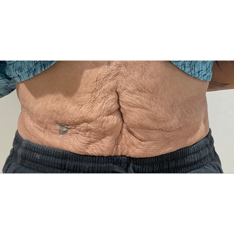 After Image: Renuvion Skin Tightening - front