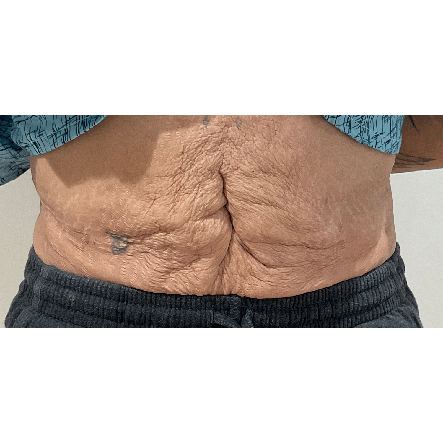 After Image: Renuvion Skin Tightening - front