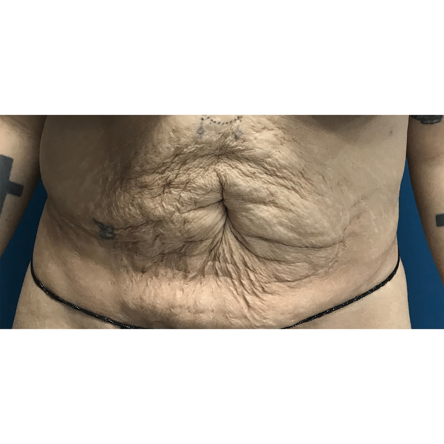 Before Image: Renuvion Skin Tightening - front