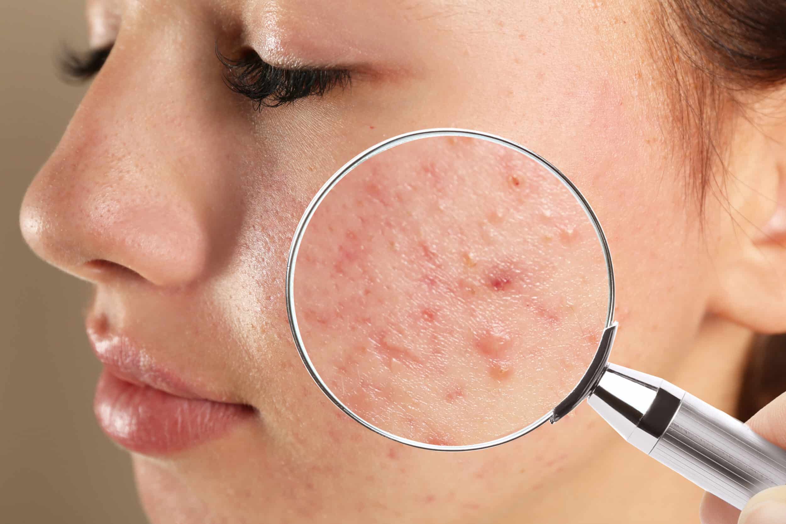 A close-up shot of a woman with acne on her cheek and jaw