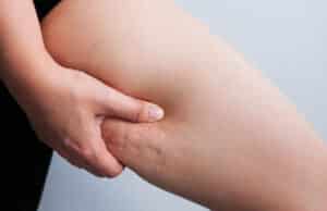 A cropped shot of cellulite on a woman's thigh before Aveli®